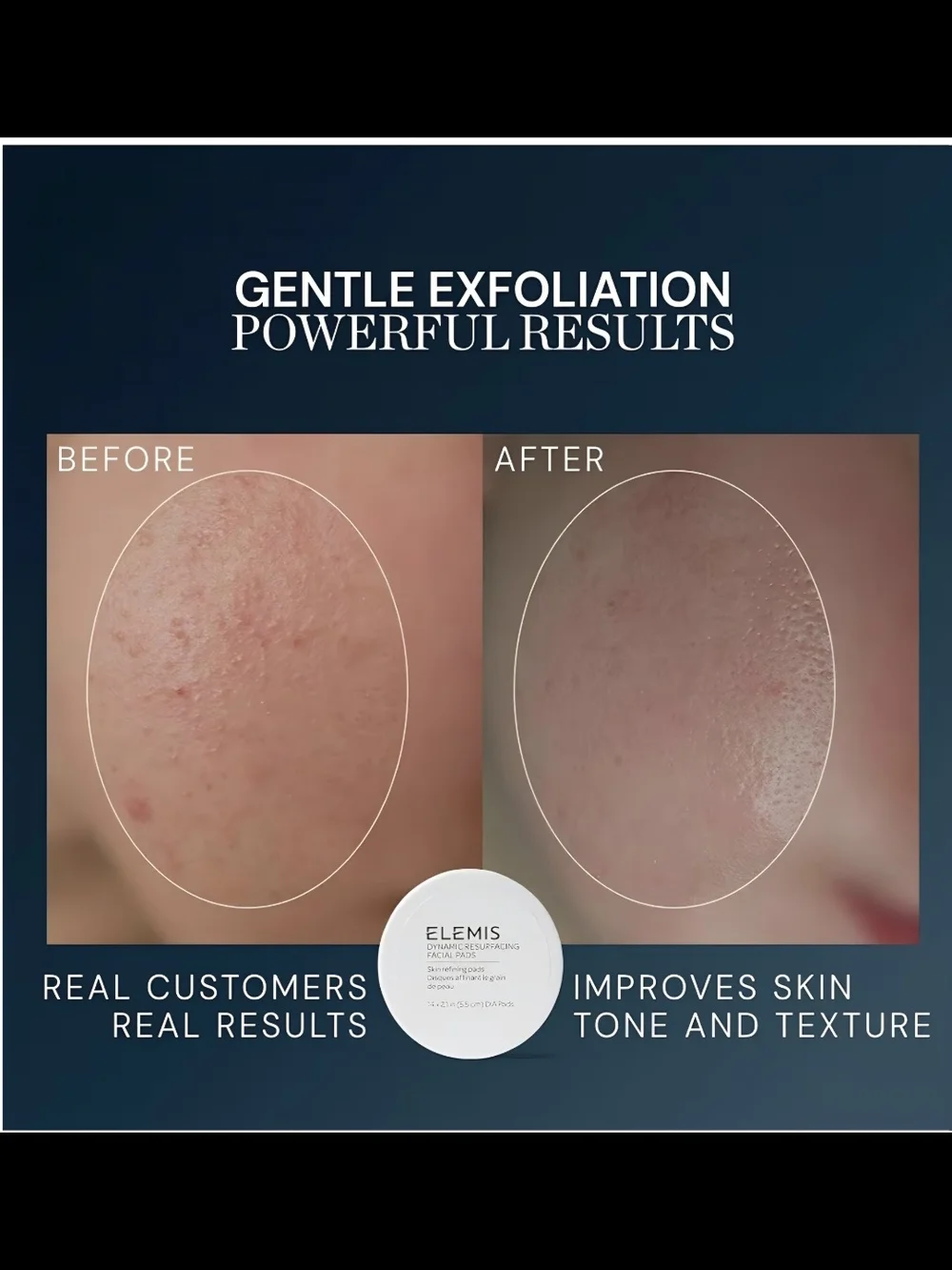 ELEMIS Dynamic Resurfacing Facial Pads - Light Blue